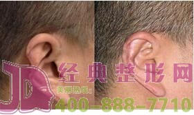 蕪湖耳部再造價格