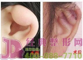 蕪湖耳垂畸形修復價格