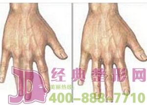 泰州并指分指價(jià)格