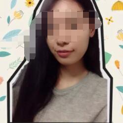 经过2年时间的牙齿矫正