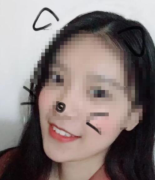 经过2年时间的牙齿矫正