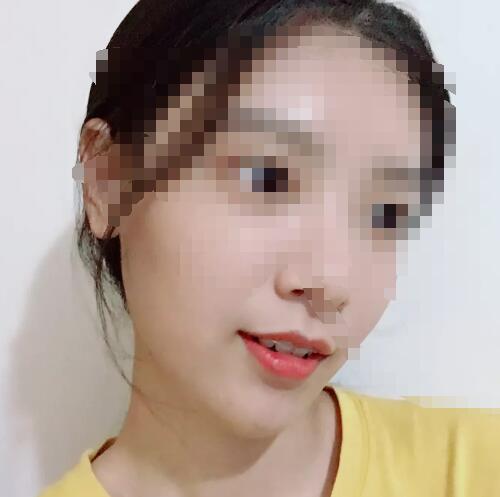 经过2年时间的牙齿矫正