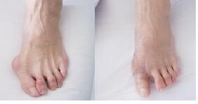 蕪湖拇外翻（大腳骨）矯正價格