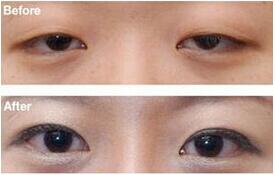 淮南眼瞼下垂矯正術要多少錢才有效果呢？