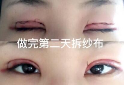 上海九院周一雄医生做的全切双眼皮 仅仅花了4200元