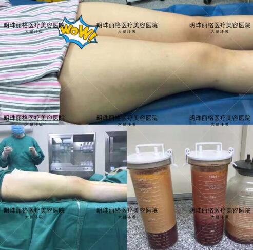贛州明珠麗格520整形優惠活動