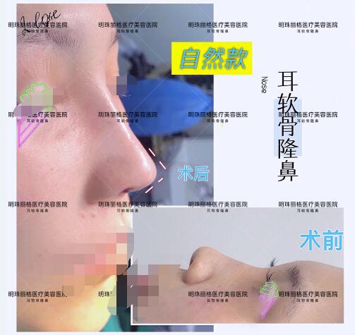 贛州明珠麗格520整形優惠活動