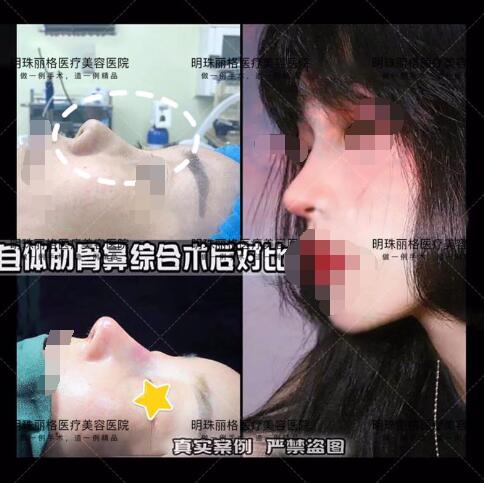 贛州明珠麗格520整形優惠活動