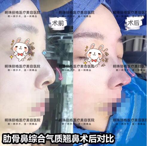 贛州明珠麗格520整形優惠活動