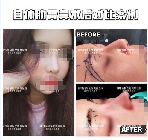 贛州明珠麗格520整形優惠活動