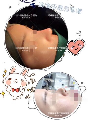 贛州明珠麗格520整形優惠活動