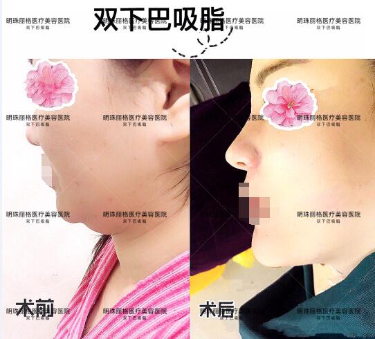 贛州明珠麗格520整形優惠活動