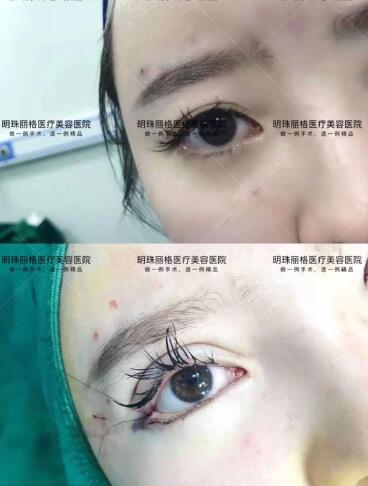 贛州明珠麗格520整形優惠活動