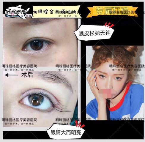 贛州明珠麗格520整形優惠活動