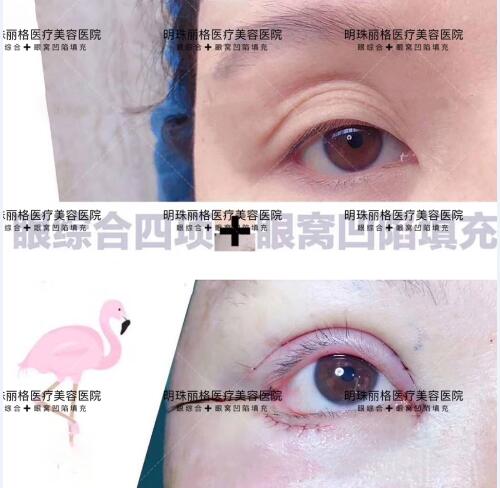 贛州明珠麗格520整形優惠活動