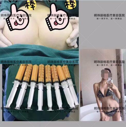 贛州明珠麗格520整形優惠活動