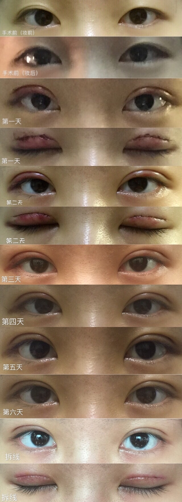 美式亮瞳双眼皮 手术价格是5840元