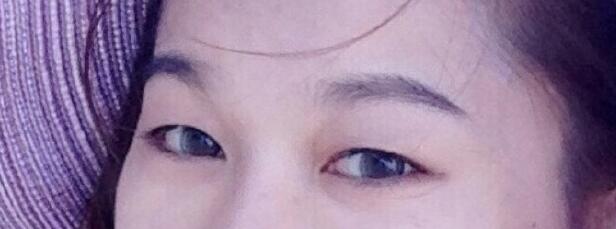 显微动态双眼皮+去脂 想做的可以看下