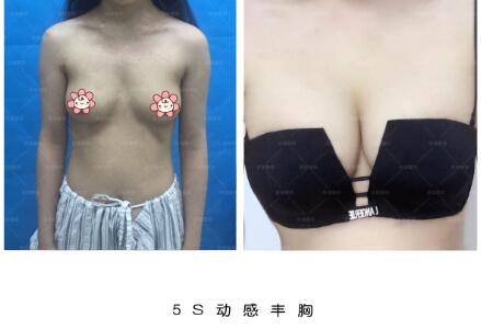 邯郸京美5S动感丰胸真人案例分享前后对比图