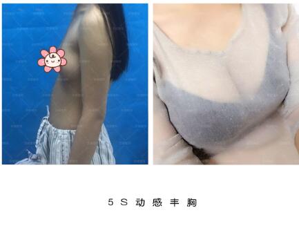 邯郸京美5S动感丰胸真人案例分享前后对比图