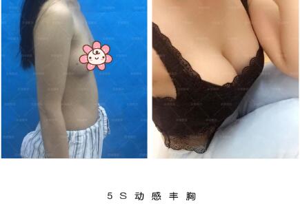 邯郸京美5S动感丰胸真人案例分享前后对比图