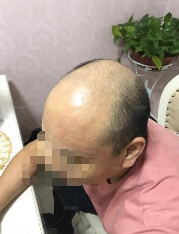 邯郸京美植发手术真人案例分享前后对比图