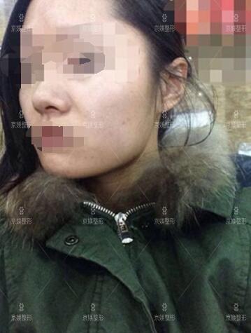 邯郸京美肉毒素注射真人案例分享前后对比图