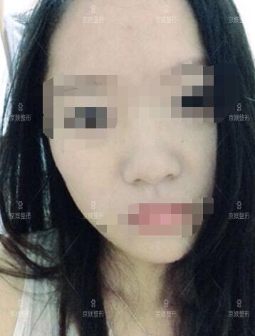 邯郸京美肉毒素注射真人案例分享前后对比图