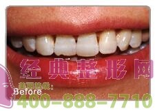 龍巖烤瓷牙價格