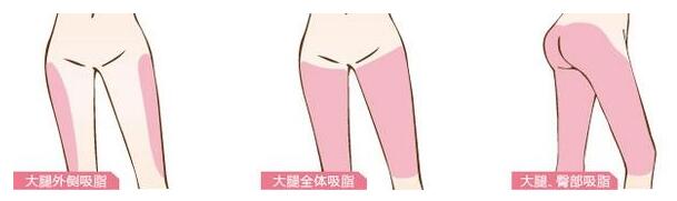 大腿吸脂手术要请假多少天 4-5天左右可行吗