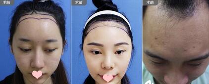 南宁脱发怎么办