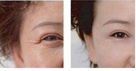 朝陽眼部除皺價格10000-20000元/部位 全新價格表上線