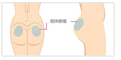 假体丰臀恢复时间要怎么做才能恢复快