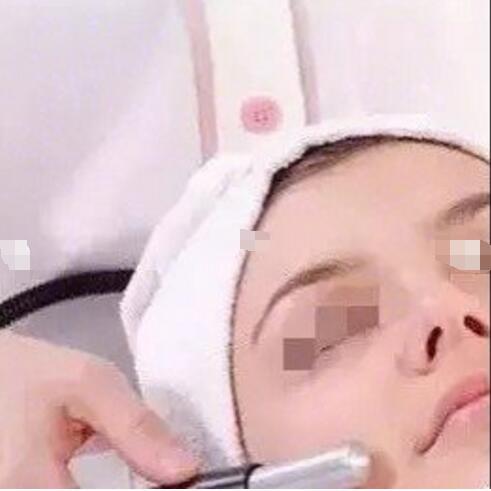 激光去除红血丝术4-5次疗程