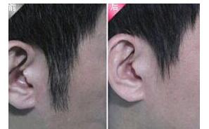 大興安嶺九月發(fā)際線脫毛全新價(jià)格表來(lái)襲 3000-4000/療程