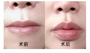 北海薄唇增厚全新價格表上線了