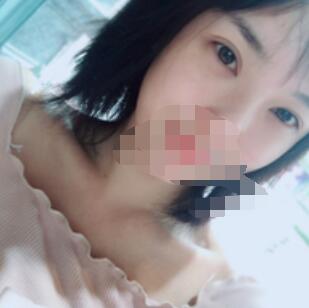 广州全切去皮去脂双眼皮案例