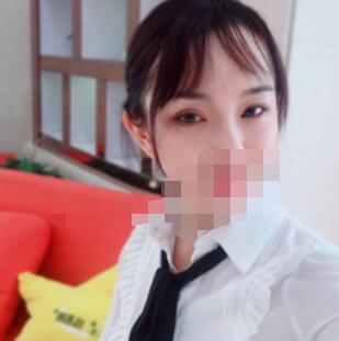 广州全切去皮去脂双眼皮案例
