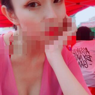 广州全切去皮去脂双眼皮案例