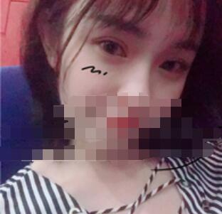 广州全切去皮去脂双眼皮案例