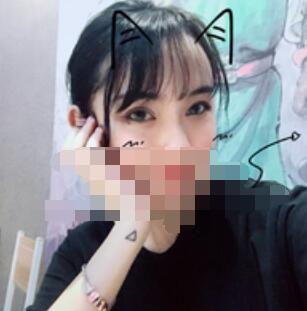 广州全切去皮去脂双眼皮案例