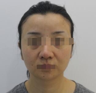 广州下巴吸脂案例