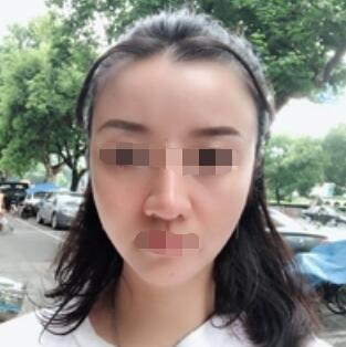 广州下巴吸脂案例