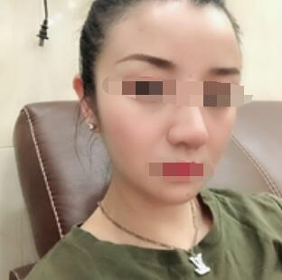 广州下巴吸脂案例