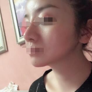 广州下巴吸脂案例