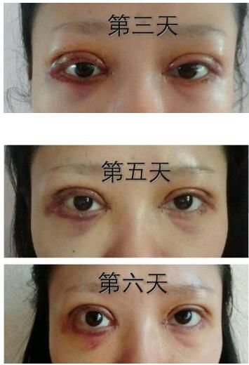 武汉做双眼皮案例 30多天的恢复过程