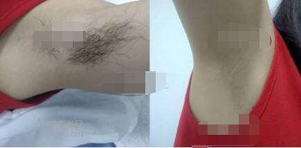 臨滄激光脫腋毛本月報價2000-3000元/療程