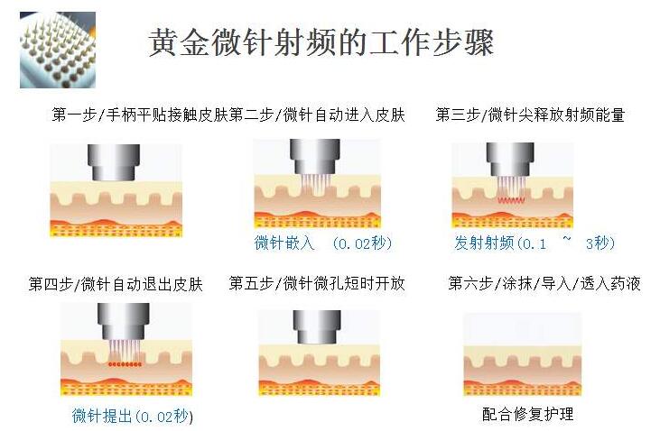 【仪器科普】快速有效去黑头收缩毛孔医美攻略 小气泡