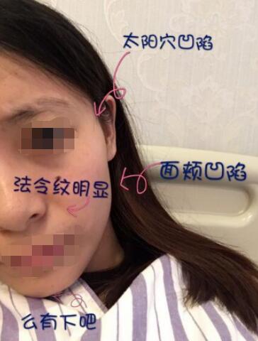 南宁全面部填充案例