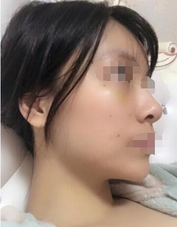 南宁全面部填充案例